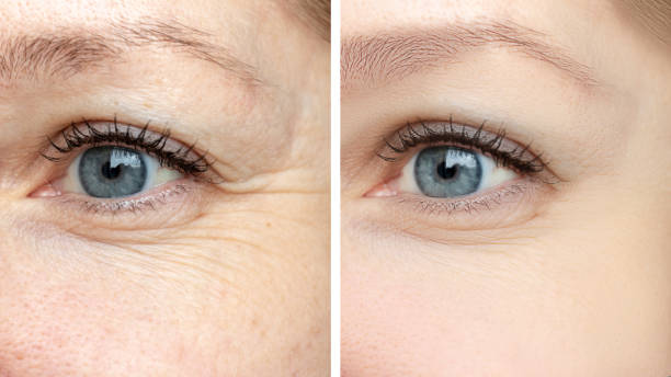 How to Get Rid of Crow’s Feet Without Botox